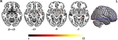 Hippocampal morphological atrophy and distinct patterns of structural covariance network in Alzheimer’s disease and mild cognitive impairment